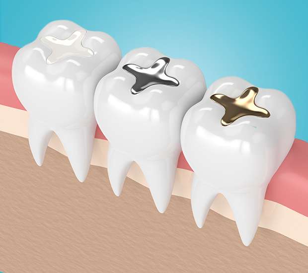 Cedar Park Composite Fillings