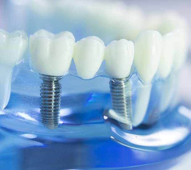 Cedar Park Dental Implants