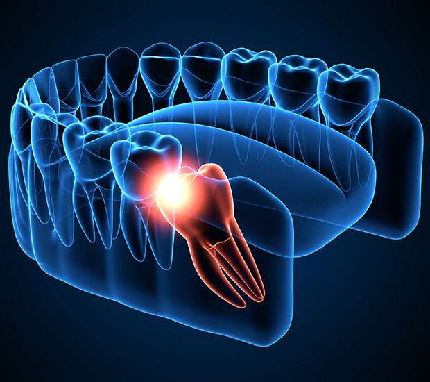 Cedar Park Wisdom Teeth Extraction